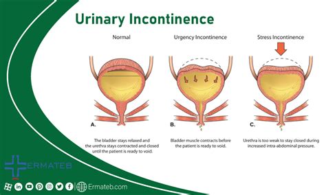 Most Common Urology Diseases