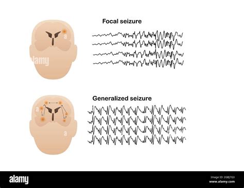 Vector illustration of seizure types demonstrating by onset and brain ...