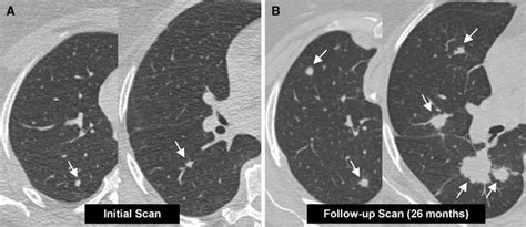 56 Year Old Woman With Breast Cancer Breast Cancer Cell Grade 3 And Download Scientific