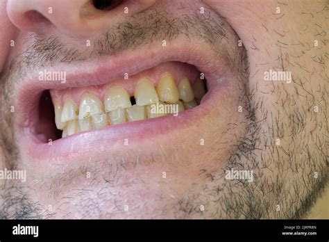 Ugly Yellow Teeth