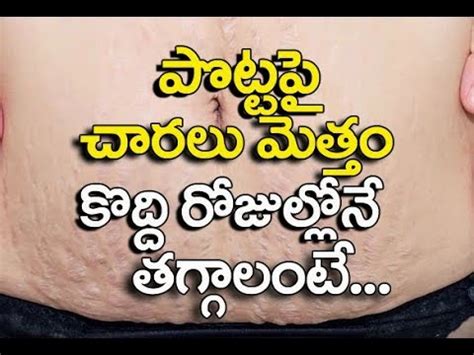 remove pregnancy stretch marks  telugu beauty tips  telugu
