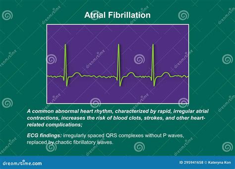 Ecg In Atrial Fibrillation 3d Illustration 295941658