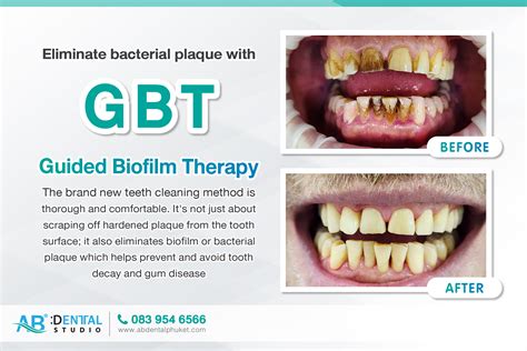 Eliminate Bacterial Plaque With Guided Biofilm Therapy Gbt