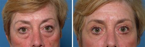 Blepharoplasty Photos Naples Fl Patient