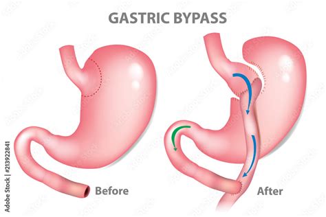 Gastric bypass surgery - RNY (Roux-en-Y ). MINI-GASTRIC BYPASS Stock ...