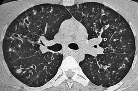 Cystic Fibrosis Ct Scan Stock Image C014 7024 Science Photo Library