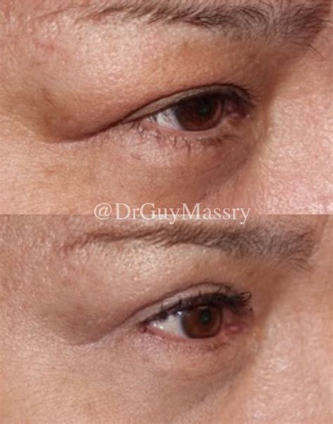 Lacrimal Gland