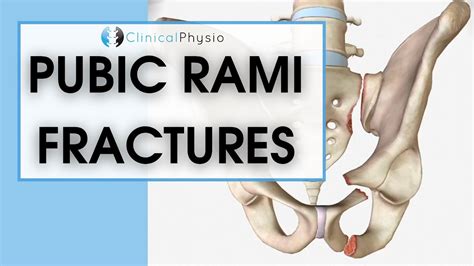 Pubic Rami Fractures | What are they? How do you treat them? - YouTube