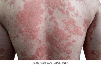 Chronic Skin Rashes Over 1 898 Royalty Free Licensable Stock Photos