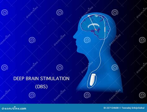 Deep Brain Stimulation For Treatment Of Parkinson Disease Stock Vector