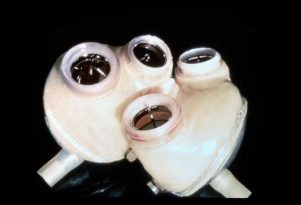 Artificial heart - wikidoc