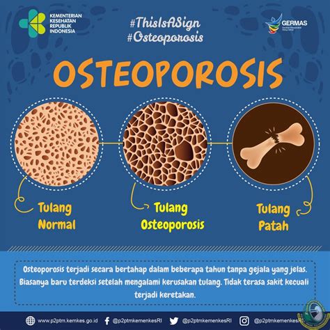 Pengertian Penyakit Osteoporosis – Studyhelp