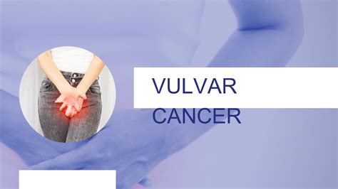 Ppt Vulvar Cancer Dr Seema Singh Powerpoint Presentation Free To