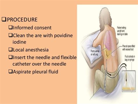 Pleural effusion