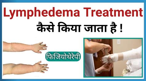 Lymphedema Treatment Lymphedema Physiotherapy Treatment Breast Cancer Related Lymphedema