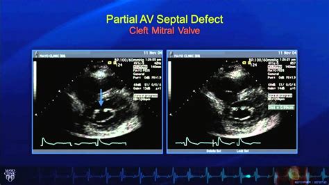 Echo Tutorial Echo Assessment Of Adults With Congenital Heart Disease