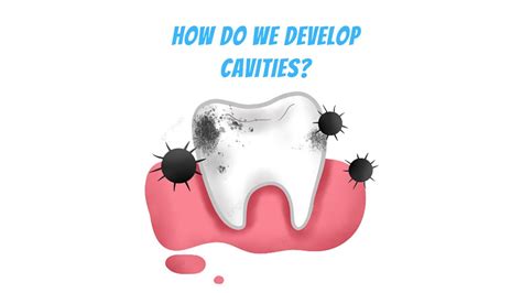 How Cavities Develops From Tooth Decay 3d Animation Youtube