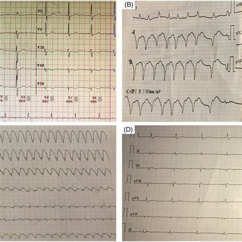 A Baseline Electrocardiogram Ecg Was Normal Before Immune