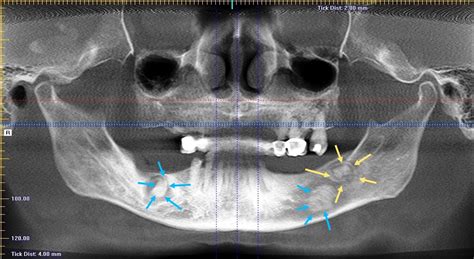 Pathology Outlines Cemento Osseous Dysplasia