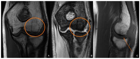 juvenile osteochondritis dissecans  case report