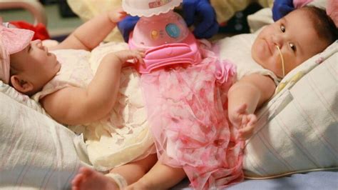 Formerly Conjoined Twins Doing Great Five Years After Being Separated