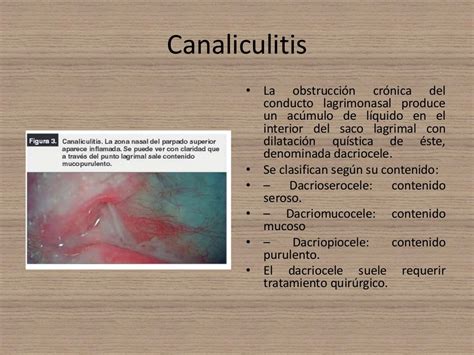 Dacriocistitis Diagnóstico Y Tratamiento