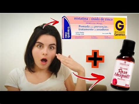 NISTATINA ÓXIDO DE ZINCO e ÓLEO DE ROSA MOSQUETA YouTube