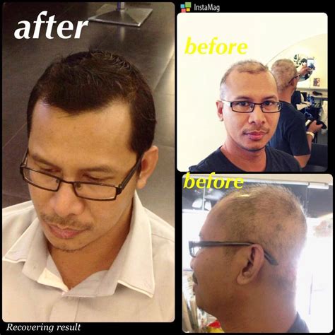 demodex-treatment-before-after | Ungex - Ungex | Demodex treatment