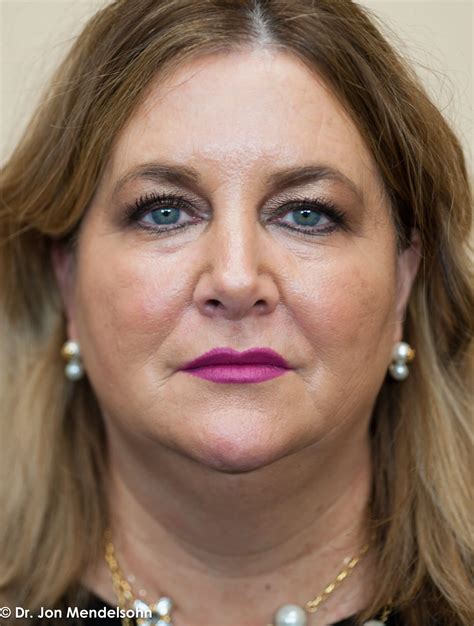 Eyelid Services – Advanced Cosmetic Surgery & Laser Center