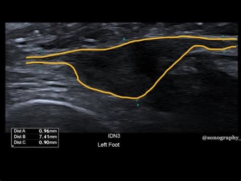 Ultrasound Of Mortons Neuromas Youtube