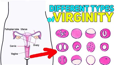 hymen variants overview types  treatment youtube