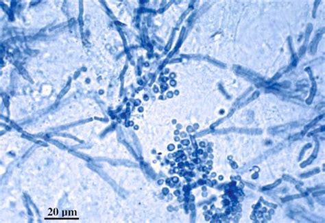 Tinea Versicolor Microscope