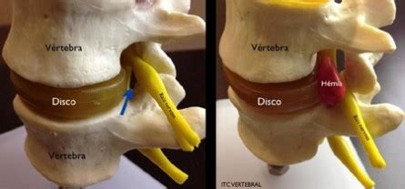 Pontos De Acupuntura Para O Tratamento De H Rnia De Disco