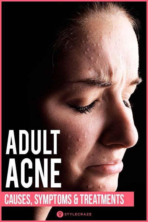 Comedonal acne causes how to treat it ways to prevent it – Artofit