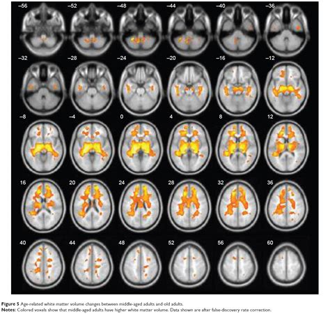 A Voxel Based Morphometric Study Of Age And Sex Related Changes In Wh NDT