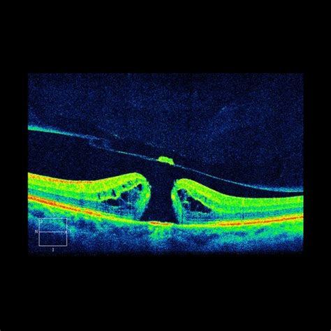 Macular Hole Surgery - St. Thomas Eye Hospital