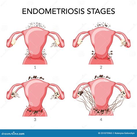 Endometriosis In Armpit at Terrance Mitchell blog