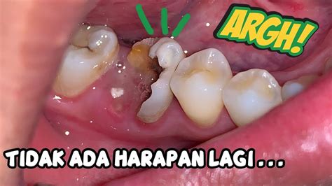 contoh gigi   bisa ditambal  koleksi gambar