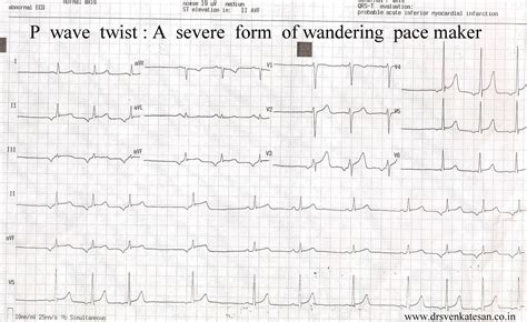 changing p wave axis | Dr.S.Venkatesan MD