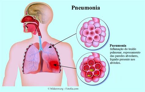 Pneumonia Passa Para Outras Pessoas