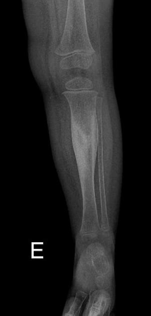 Osteoblastom Radiologie