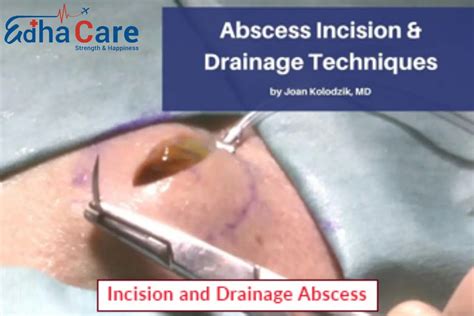 Incision And Drainage Abscess Incision And Drainage Procedure