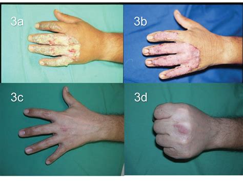 What Do 1st 2nd And 3rd Degree Burns Look Like A Visual Guide Allure