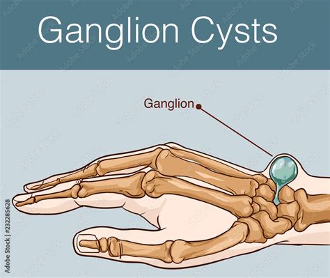 vector illustration of a Ganglion cyst Stock Vector | Adobe Stock