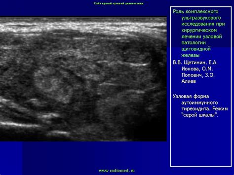 УЗИ щитовидная железа. + | Портал радиологов