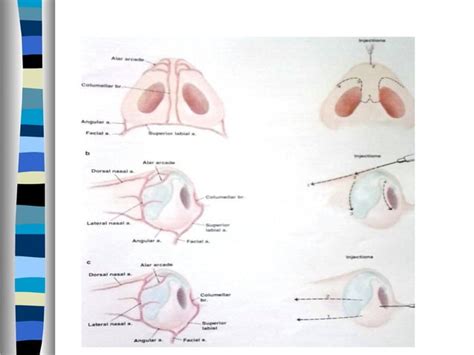 Rhinoplasty Approaches Anatomy Techniques Ppt Free Download