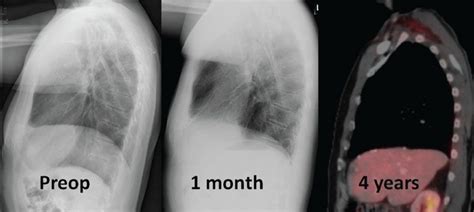 laparoscopic diaphragmatic plication thoracic key