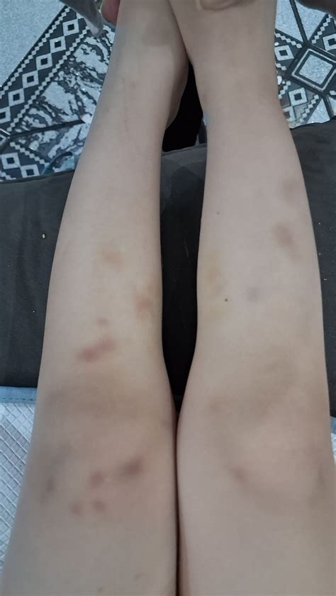 Mancha Roxa No Corpo De Criança - Manchas Roxas nas pernas | BabyCenter
