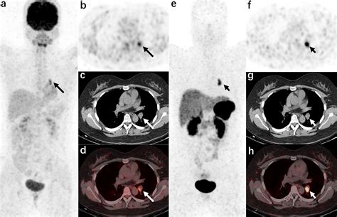 Frontiers Comparison Of Diagnostic Efficacy Of F Fdg Pet Ct And