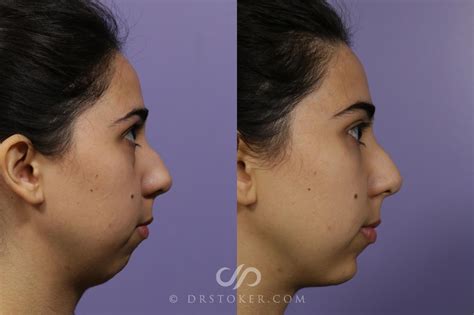 Jawline Fillers Before After Results At Skinly